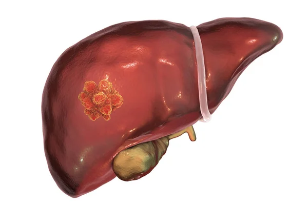 Ilustração do cancro do fígado — Fotografia de Stock