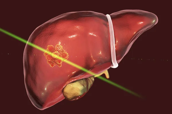Liver cancer treatment with laser