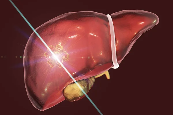 Liver cancer treatment with laser