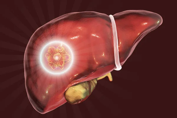 肝臓がんの治療。概念図 — ストック写真