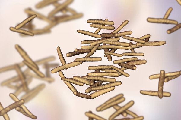 Mycobaccum avium intracellulare
