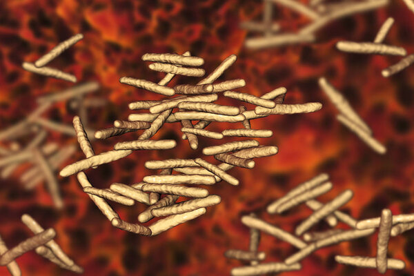 Mycobaccum avium intracellulare
