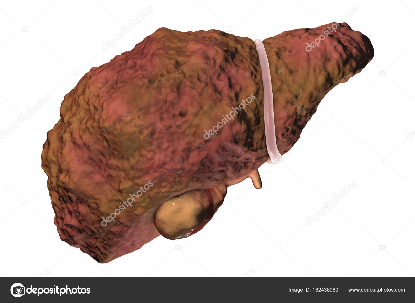 Illustrazione Di Cirrosi Epatica Foto Stock Katerynakon