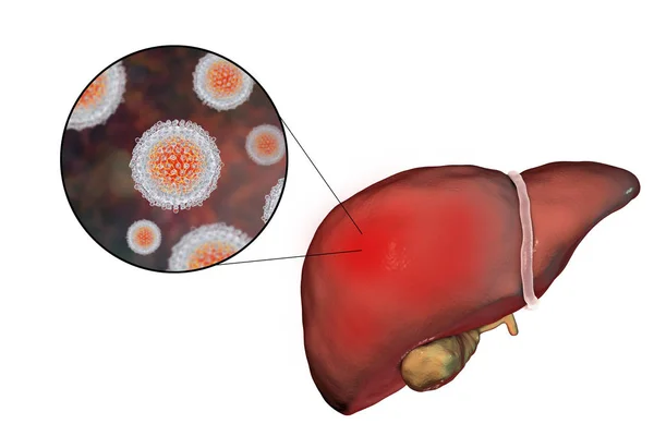Hígado con infección por hepatitis C — Foto de Stock