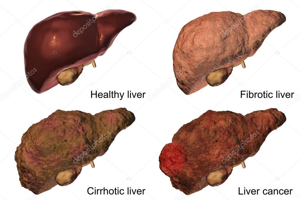 Liver disease progression in Hepatitis B and C viral infection