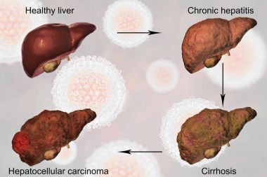 Hepatit C virüs enfeksiyonu ilerlemesinde karaciğer hastalığı