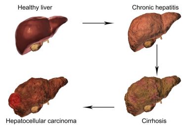 Liver disease progression in Hepatitis B and C virus infection clipart