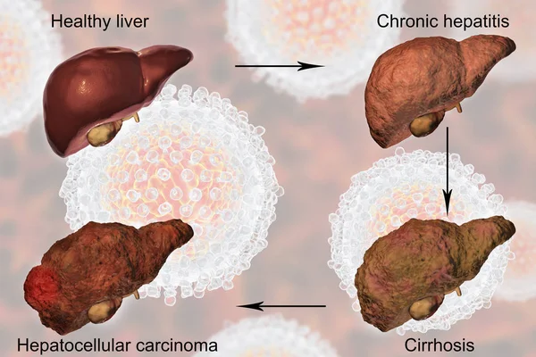 Liver disease progression in Hepatitis C virus infection