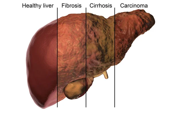 Hepatit B ve C virüs enfeksiyonu ilerlemesinde karaciğer hastalığı — Stok fotoğraf