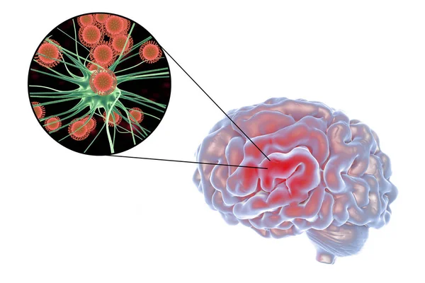 Virová encefalitida ilustrace — Stock fotografie
