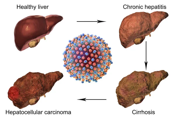 C 型肝炎ウイルス感染の肝疾患の進行 — ストック写真