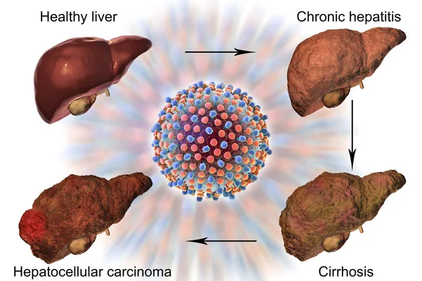 Liver disease progression in Hepatitis C virus infection