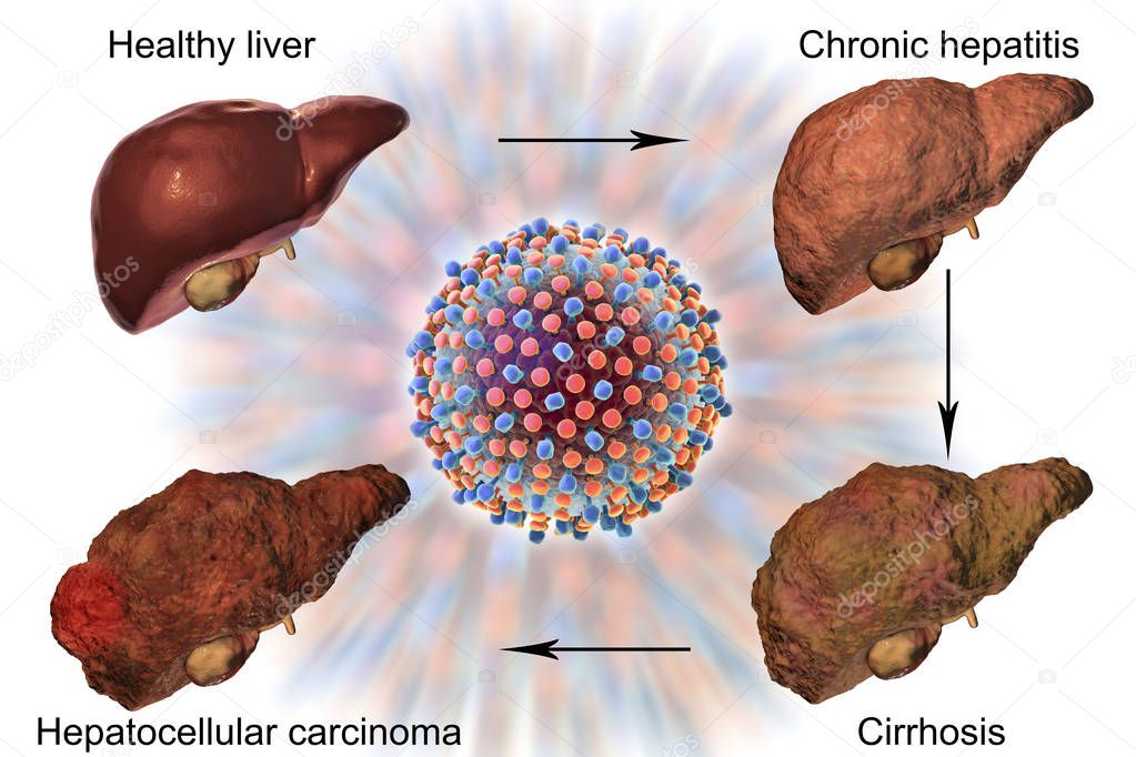 Liver disease progression in Hepatitis C virus infection