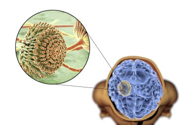 Aspergilloma of the brain and close-up view of fungi Aspergillus clipart