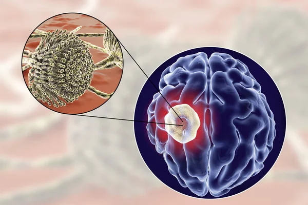 Aspergilloma του στον εγκέφαλο και γκρο πλαν θέα των μυκήτων Aspergillus — Φωτογραφία Αρχείου