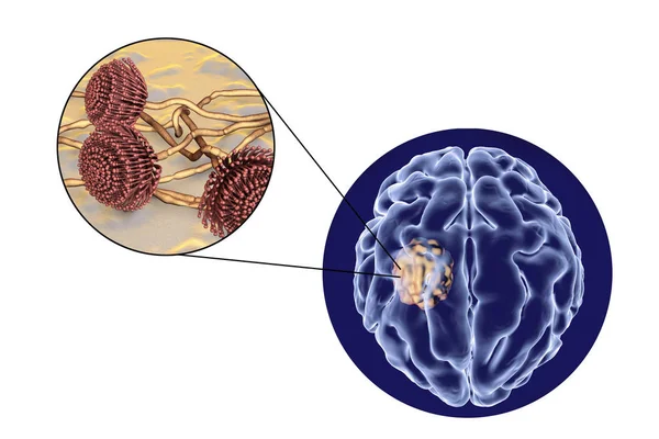 Аспергиллома головного мозга и близкий обзор грибов Aspergillus — стоковое фото