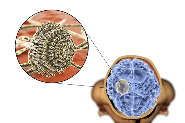 Aspergilloma mózgu i zbliżenie w widoku grzyby Aspergillus — Zdjęcie stockowe