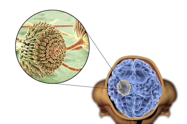 Aspergilloma av hjärnan och närbild beskådar av svampar Aspergillus — Stockfoto