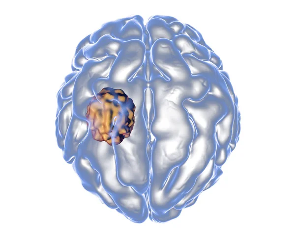 Aspergilomem mozku — Stock fotografie