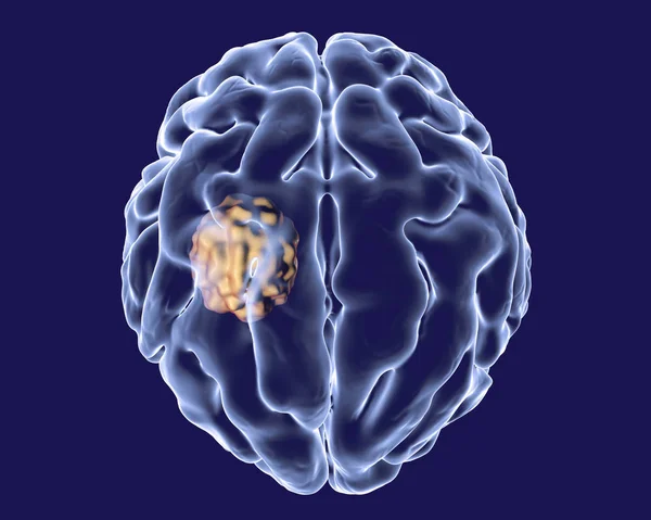 Aspergilloma of the brain — Stock Photo, Image