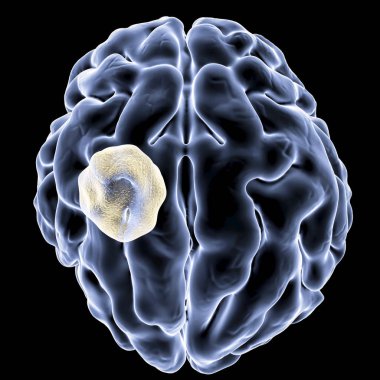 Aspergilloma beyin