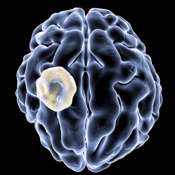 Аспергілома мозку — стокове фото