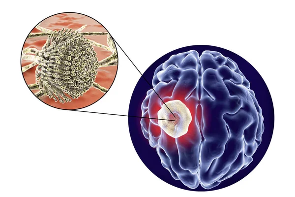 Aspergilloma του στον εγκέφαλο και γκρο πλαν θέα των μυκήτων Aspergillus — Φωτογραφία Αρχείου