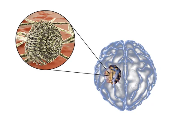 Aspergilloma av hjärnan och närbild beskådar av svampar Aspergillus — Stockfoto