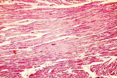 Kalp hipertrofisi photomicrograph