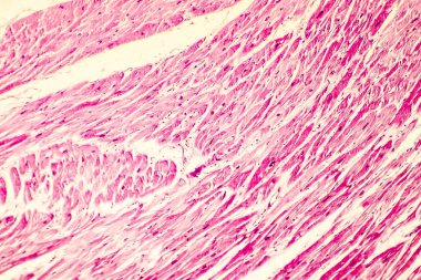 Kalp hipertrofisi photomicrograph