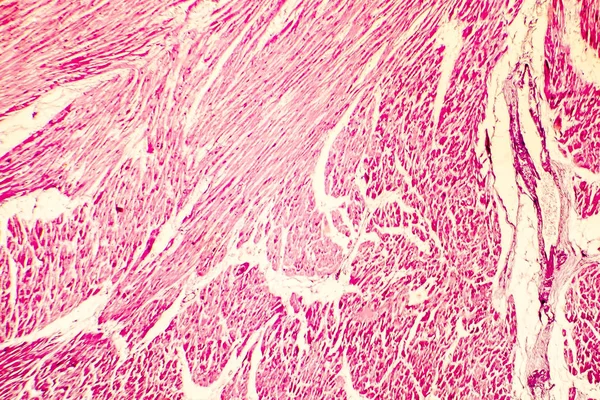 Heart hypertrophy photomicrograph