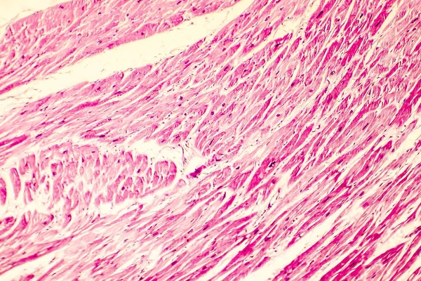 Photomicrograph przerost serca — Zdjęcie stockowe