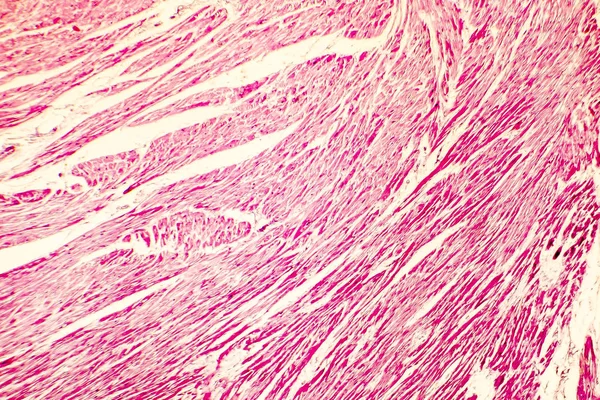 Photomicrograph przerost serca — Zdjęcie stockowe