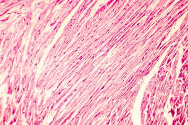Kalp hipertrofisi photomicrograph