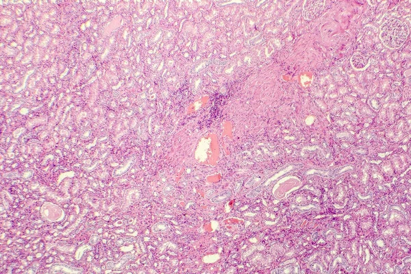 Renal arter hiyalin dejenerasyon