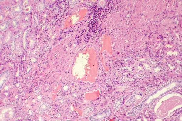 Dégénérescence hyaline de l'artère rénale — Photo