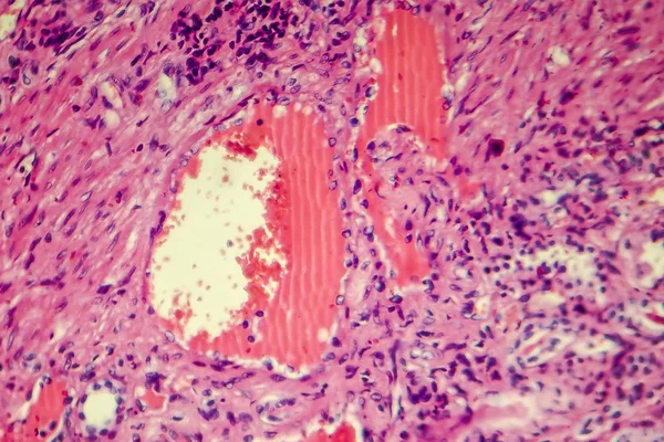 Гіалінова дегенерація ниркової артерії — стокове фото