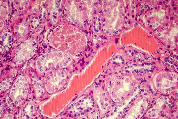 Гиалинная дегенерация почечной артерии — стоковое фото