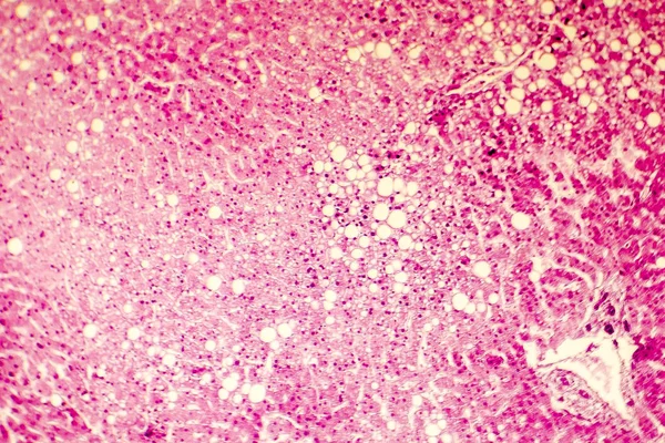 脂肪肝の光学顕微鏡像 — ストック写真