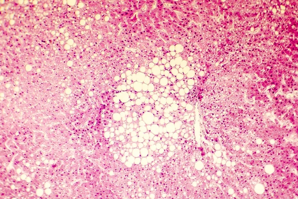 Micrografía ligera de un hígado graso — Foto de Stock
