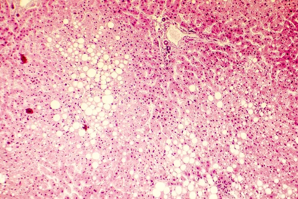 Micrografo leggero di un fegato grasso — Foto Stock