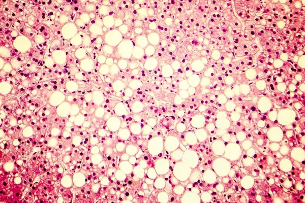 Micrografía ligera de un hígado graso — Foto de Stock