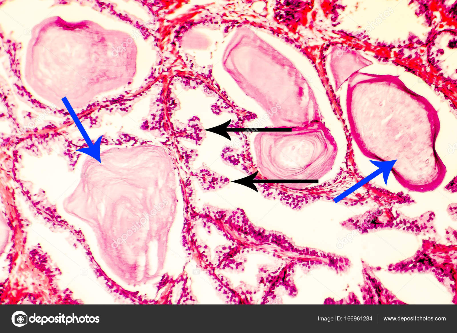 prostata strutturata