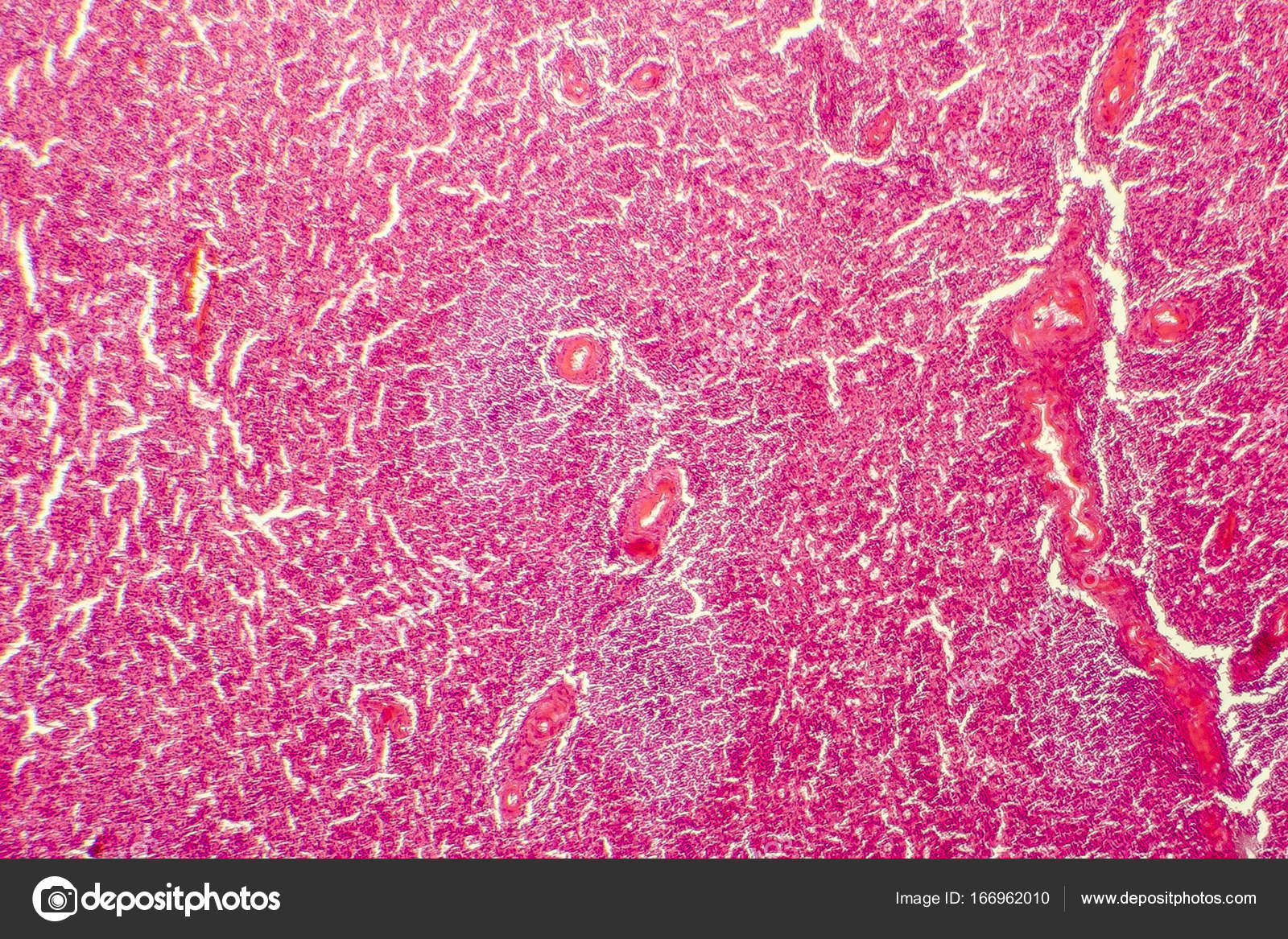 Vascular estromalía degeneración