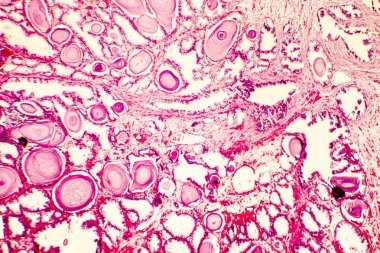 Prostat hiperplazisi photomicrograph