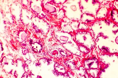 Prostat hiperplazisi photomicrograph