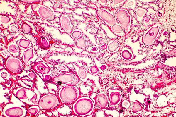 前立腺肥大症の顕微鏡写真 — ストック写真