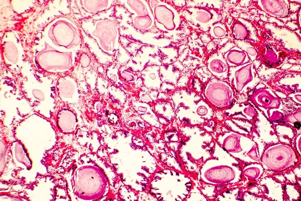 Photomicrograph of prostate hyperplasia — Stock Photo, Image