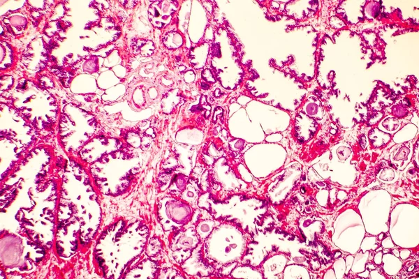 전립선 비 대 증의 photomicrograph — 스톡 사진