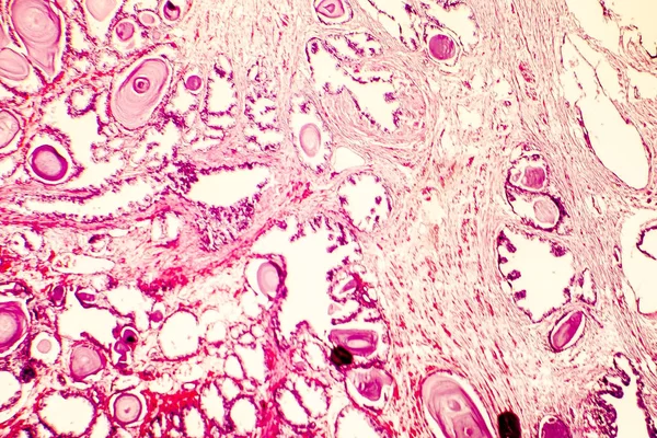 前列腺增生症的显微 — 图库照片